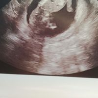 Ayuda con método ramzi: niño o niña? - 1