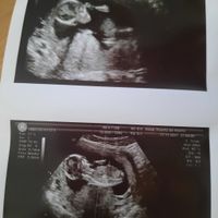 Ayuda con método ramzi: niño o niña? - 1