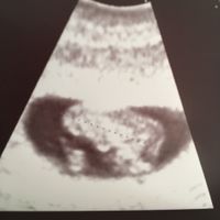 Buscadoras con síndrome de ovario poliquístico (sop) - 1