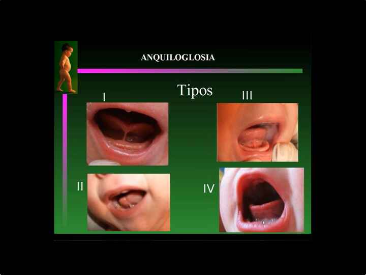 Tipos de frenillo 