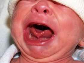 Anquiloglosia 