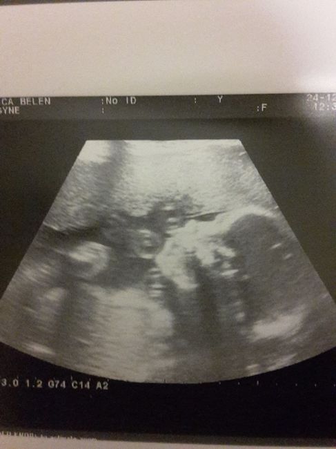 25 semanas