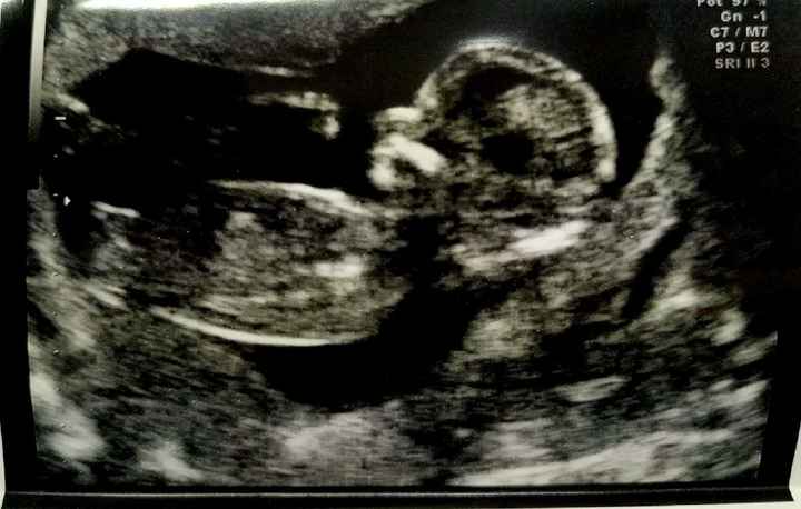 Ayuda con método ramzi: niño o niña? - 1