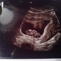 Ayuda con método ramzi: niño o niña? - 1