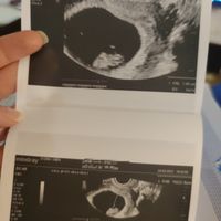 Ayuda con método ramzi: niño o niña? - 1