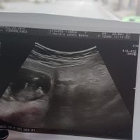 Ayuda con método ramzi: niño o niña? - 1