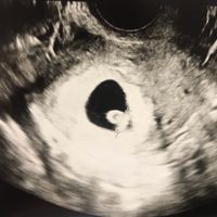 Ayuda con método ramzi: niño o niña? - 2