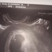 Ayuda con método ramzi: niño o niña? - 1