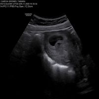 Ayuda con método ramzi: niño o niña? - 1