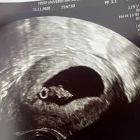 Ayuda con método ramzi: niño o niña? - 1