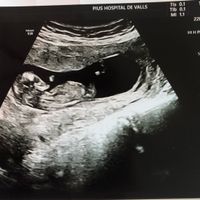 Tubérculo genital niño o niña??? - 1