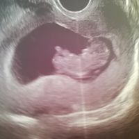 Ayuda con método ramzi: niño o niña? - 1