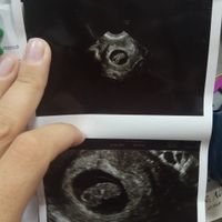 Ayuda con método ramzi: niño o niña? - 1
