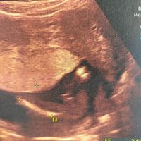 Ayuda con método ramzi: niño o niña? - 1