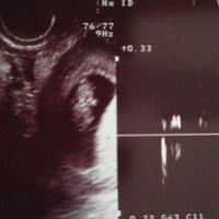 Ayuda con método ramzi: niño o niña? - 1