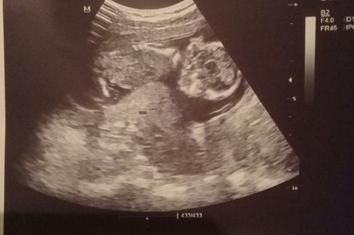 Tubérculo genital: niña - 1