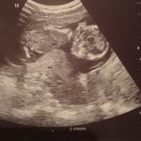 Tubérculo genital: niña - 1