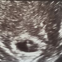 Ayuda con método ramzi: niño o niña? - 1