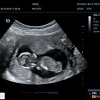 Ayuda con método ramzi: niño o niña? - 1
