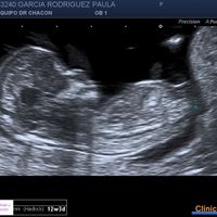 Ayuda con método ramzi: niño o niña? - 1