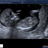 Ayuda con método ramzi: niño o niña? - 2