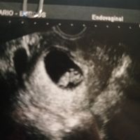 Ayuda con método ramzi: niño o niña? - 1