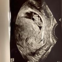 Ayuda con método ramzi: niño o niña? - 1
