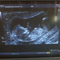 Ayuda con método ramzi: niño o niña? - 1