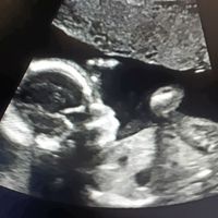 Ayuda con método ramzi: niño o niña? - 2