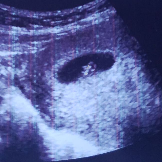 Ayuda con método ramzi: niño o niña? - 1