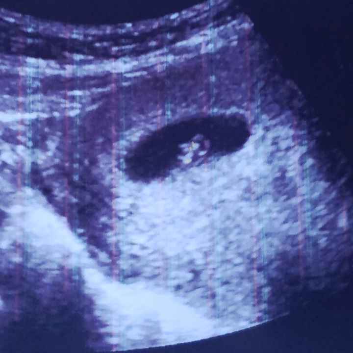 Ayuda con método ramzi: niño o niña? 16
