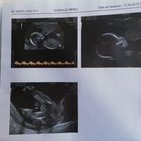 Ayuda con método ramzi: niño o niña? - 1