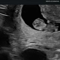 Ayuda con método ramzi: niño o niña? - 1