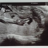 Ayuda con método ramzi: niño o niña? - 1