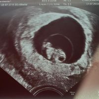 Ayuda con método ramzi: niño o niña? - 1