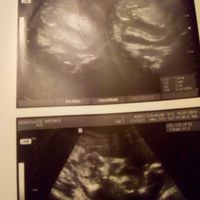 Tubérculo genital que es niño o niña?? - 1