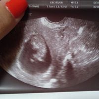 Ayuda con método ramzi: niño o niña? - 2