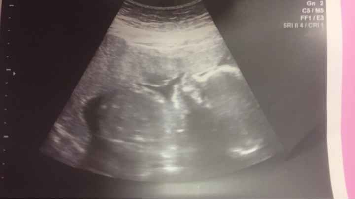 Buscadoras después de uno o varios abortos ii - 1