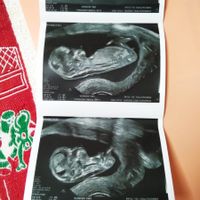 Ayuda con método ramzi: niño o niña? - 1
