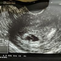 Ayuda con método ramzi: niño o niña? - 1