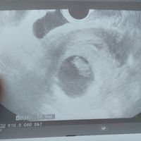 Ayuda con método ramzi: niño o niña? - 1