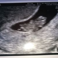 Ayuda con método ramzi: niño o niña? - 1