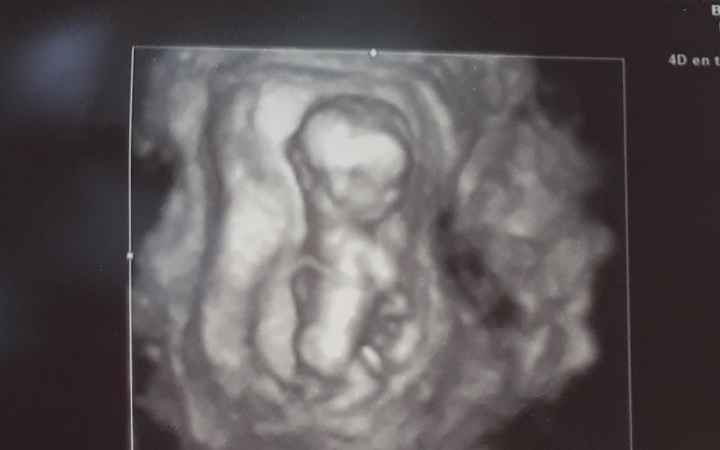 Ayuda con método ramzi: niño o niña? - 2