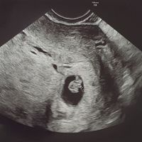Ayuda con método ramzi: niño o niña? - 1