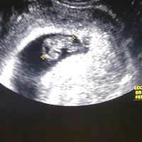 Ayuda con método ramzi: niño o niña? - 1