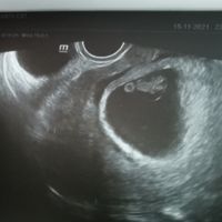 Ayuda con método ramzi: niño o niña? - 1