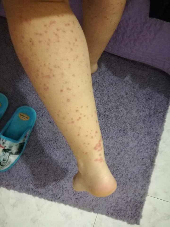 Psoriasis - 1