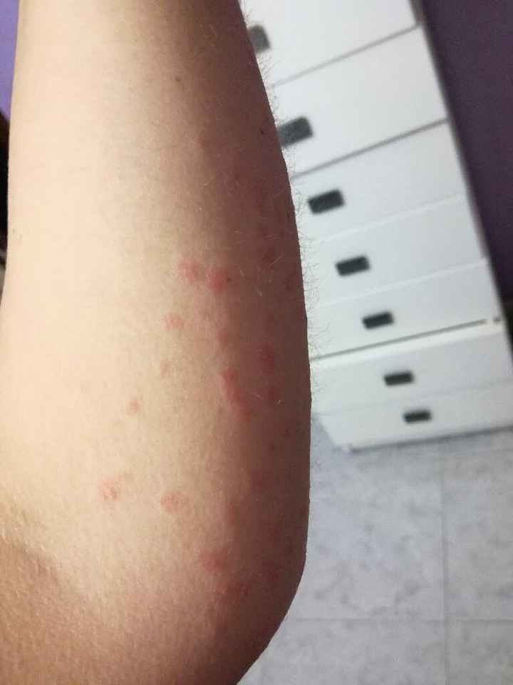 Psoriasis - 2