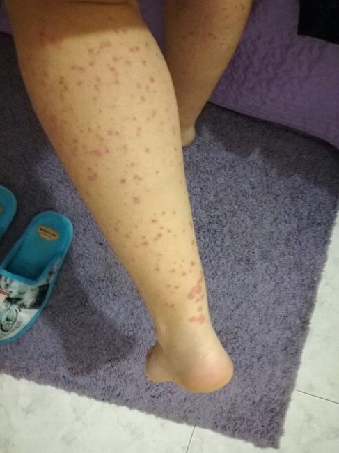 Psoriasis - 1