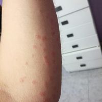 Psoriasis - 2
